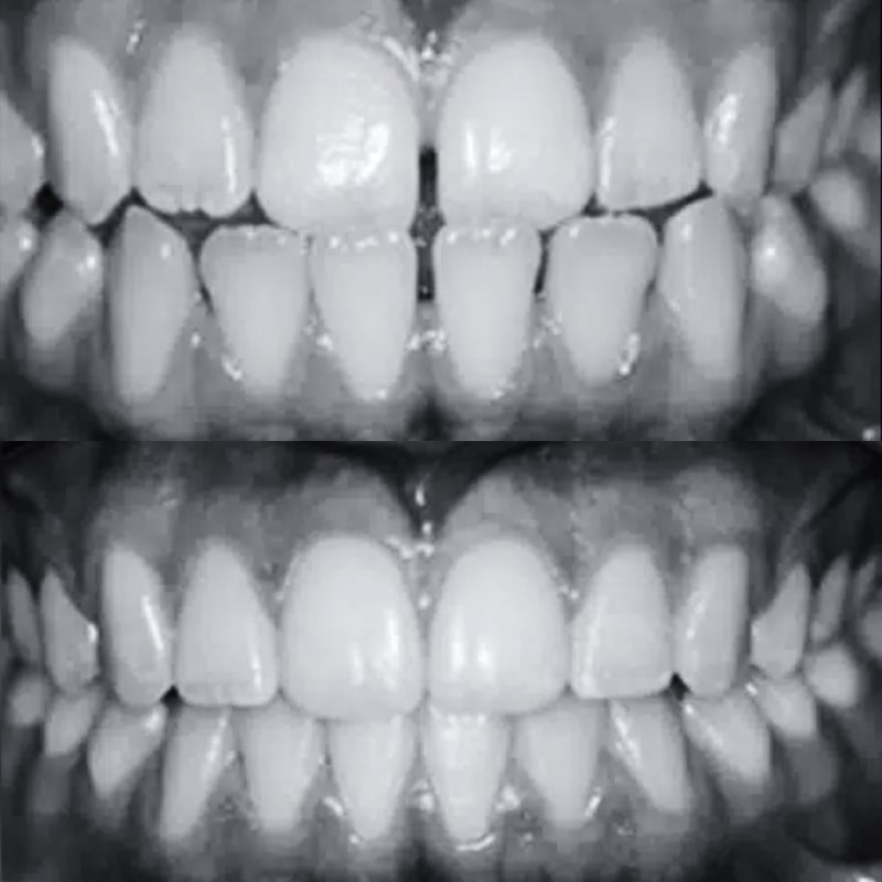 Diastema i tremy